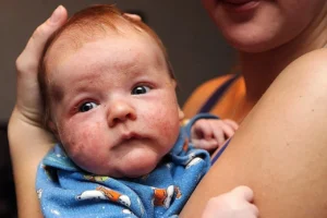 Un bébé avec de l'eczéma atopique sur le visage